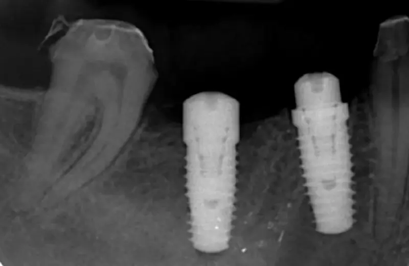 Radiographie de contrôle de deux implants et de l’os environnant