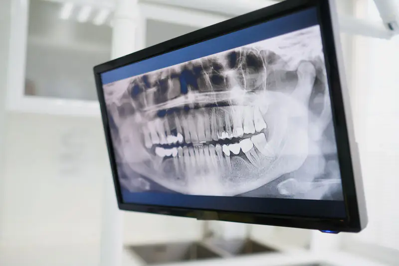 Radiographie panoramique affichée sur un écran dans une salle de soins claire, montrant les racines et l’os des deux mâchoires