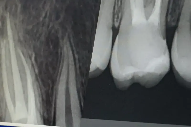 Radiographies de dents dévitalisées sur un écran de consultation, avec les canaux des racines obturés bien visibles