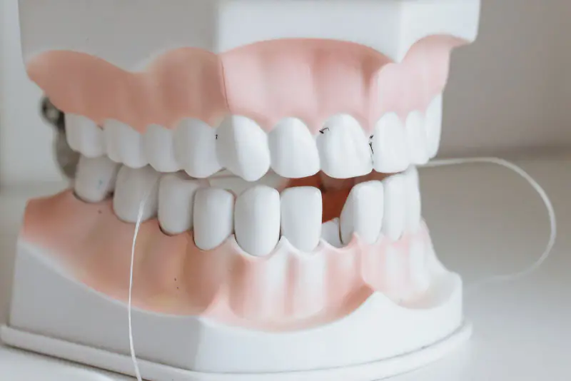 Modèle de mâchoire en résine où il manque une dent du bas, avec l’espace laissé entre les dents voisines