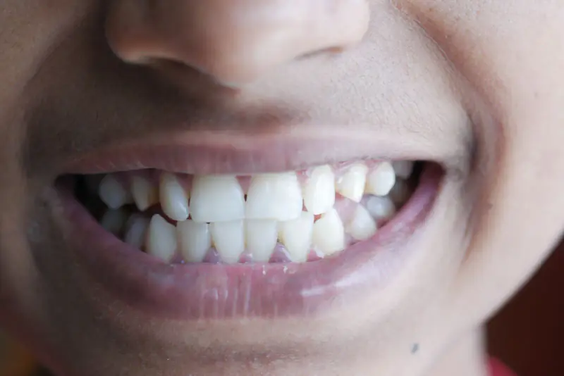 Gros plan d’un sourire détendu laissant voir des dents du haut et du bas mal alignées et qui se chevauchent