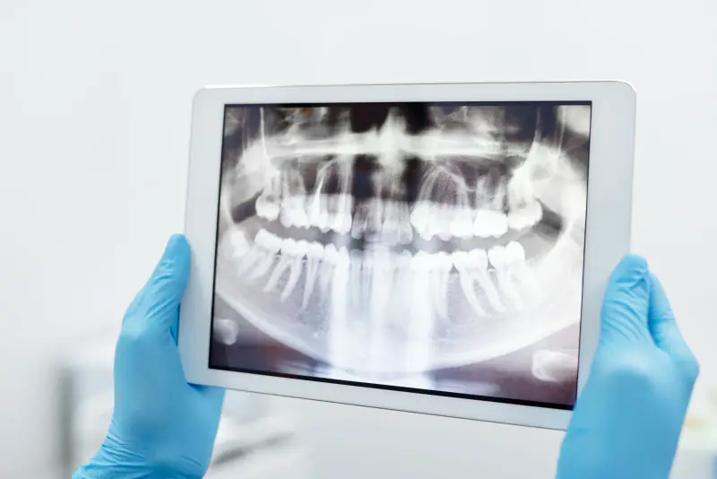 Mains gantées tenant une tablette qui affiche une radiographie panoramique dentaire, dans un cabinet clair