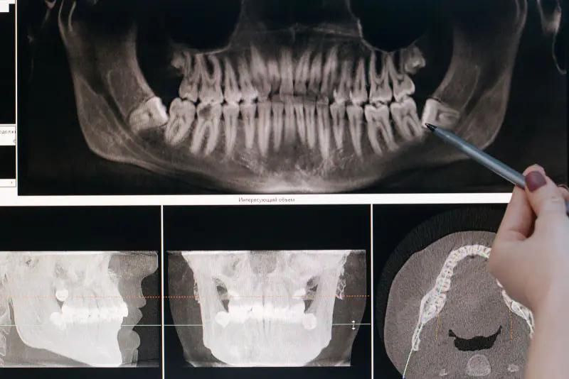 Reconstruction panoramique d’un examen Cone Beam à l’écran, un stylo tenu à la main désignant une dent de sagesse inférieure inclinée