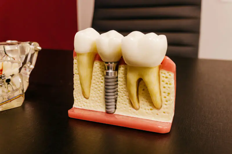 Modèle pédagogique en coupe montrant un implant dentaire entouré d’os, entre deux dents naturelles