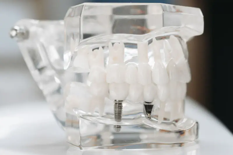 Modèle de mâchoire transparent où deux implants vissés dans l’os remplacent des dents absentes, entre des dents naturelles