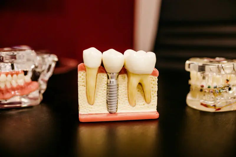 Modèle d’implant entre deux dents naturelles, encadré par deux mâchoires transparentes, l’une avec prothèse, l’autre avec bagues orthodontiques