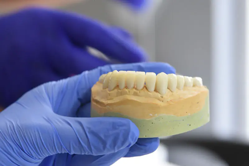Arcade inférieure complète de dents prothétiques sur un modèle en plâtre, tenue par des mains gantées de bleu