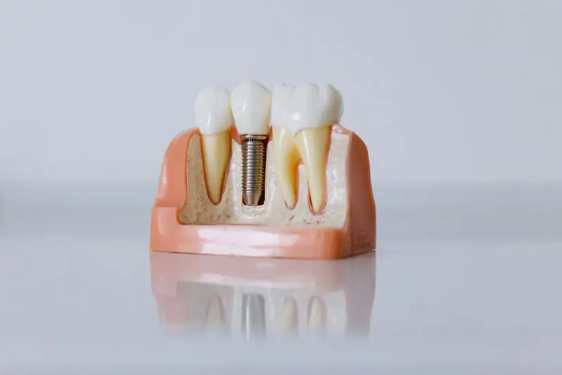 Modèle pédagogique d’un implant dentaire avec sa couronne, placé entre deux dents naturelles sur un fond blanc lumineux