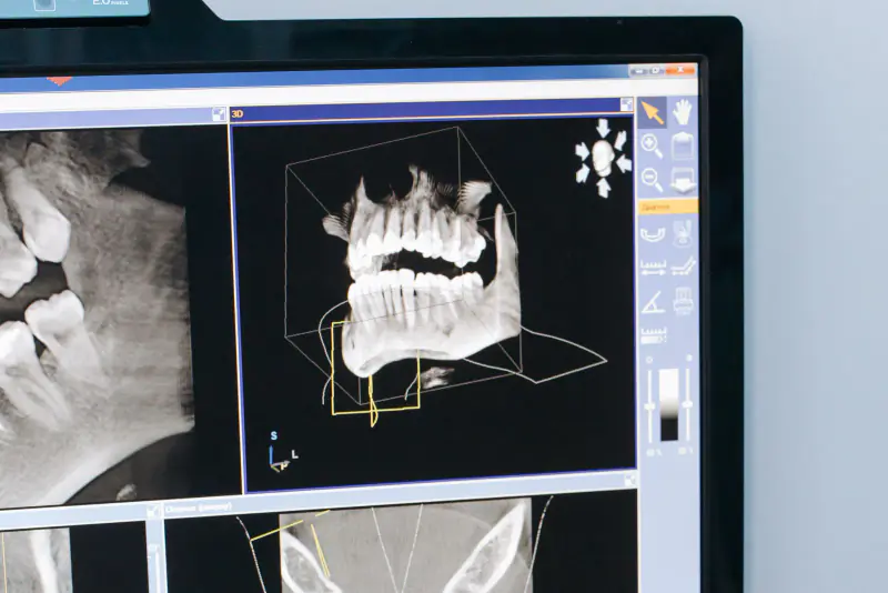 Reconstruction 3D des mâchoires et coupes d’un examen Cone Beam affichées sur un écran d’ordinateur, dans une pièce claire