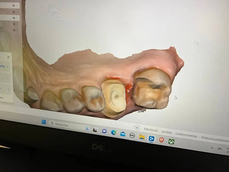 Close-up on screen of teeth prepared for crowns: the preparation margins and the surrounding gum are legible on the 3D model.