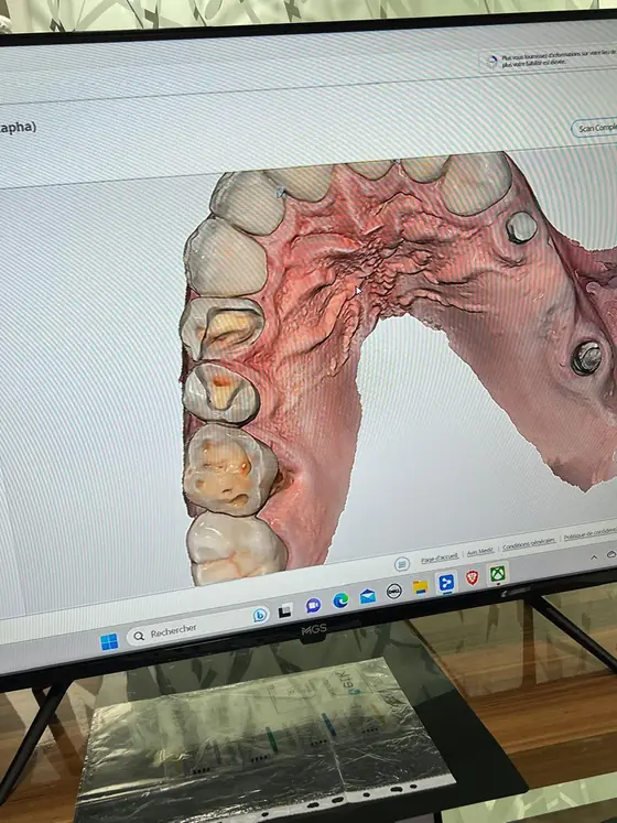 Gescannter Kiefer am Bildschirm mit metallischen Scankörpern, die auf die Implantate geschraubt sind, umgeben von verheiltem Zahnfleisch.