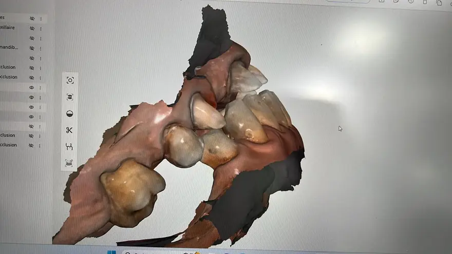 Angled view of the 3D scan of an upper arch on screen, showing both the outer tooth surfaces and the reconstructed palate.