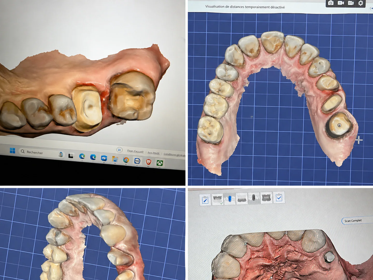 Modèles dentaires 3D issus d'empreintes numériques réalisées au cabinet