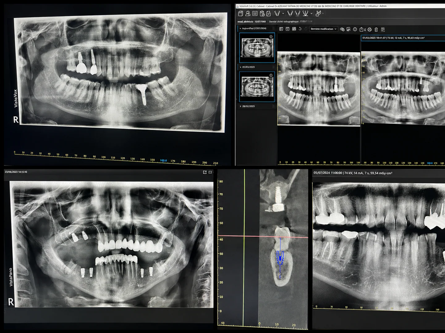 Radiographies panoramiques et coupe CBCT utilisées pour planifier et contrôler des implants dentaires