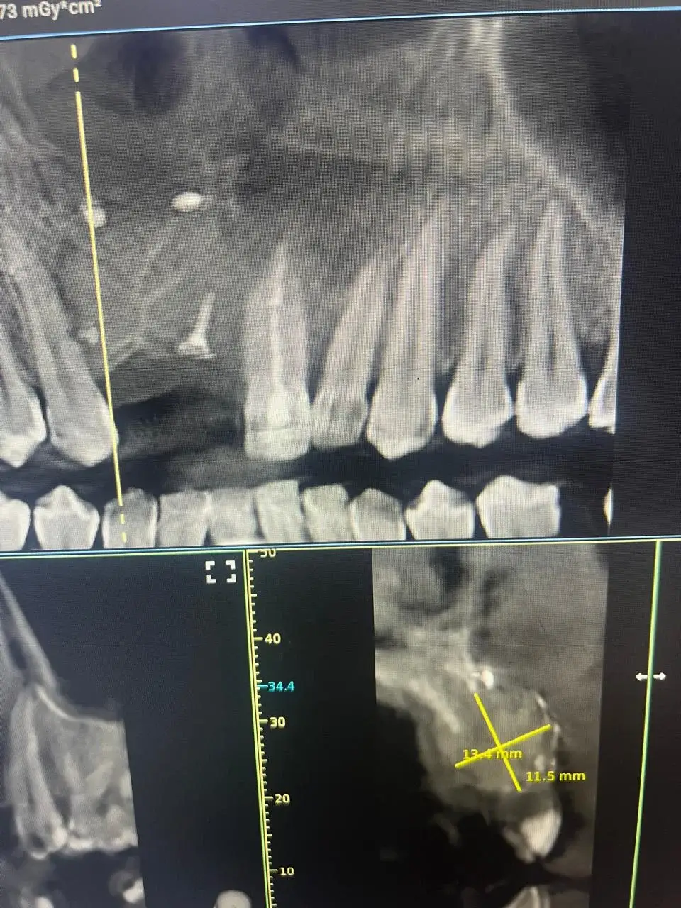 Écran de radiologie dentaire présentant une vue d’arcade et des mesures tracées sur une coupe.