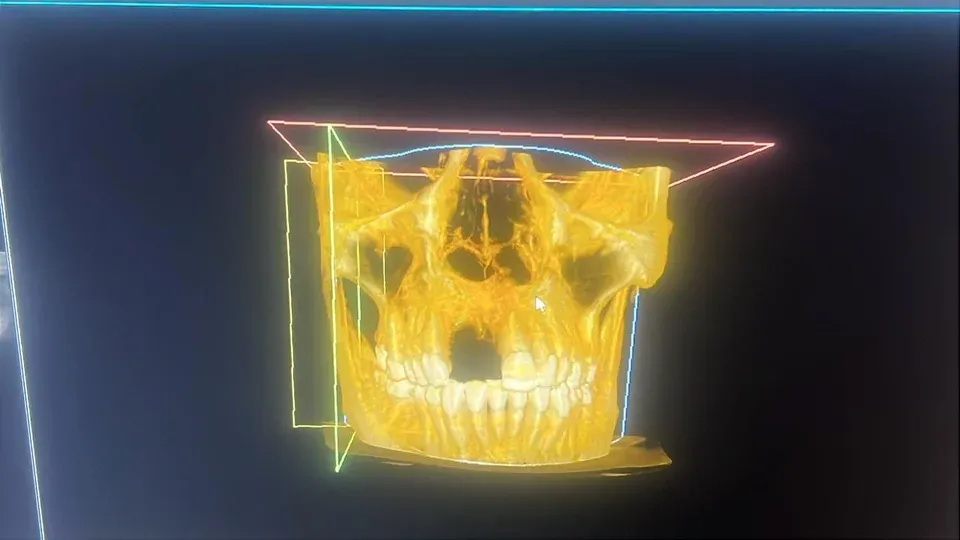 Reconstruction 3D jaune des mâchoires et des dents affichée dans un logiciel d’imagerie.