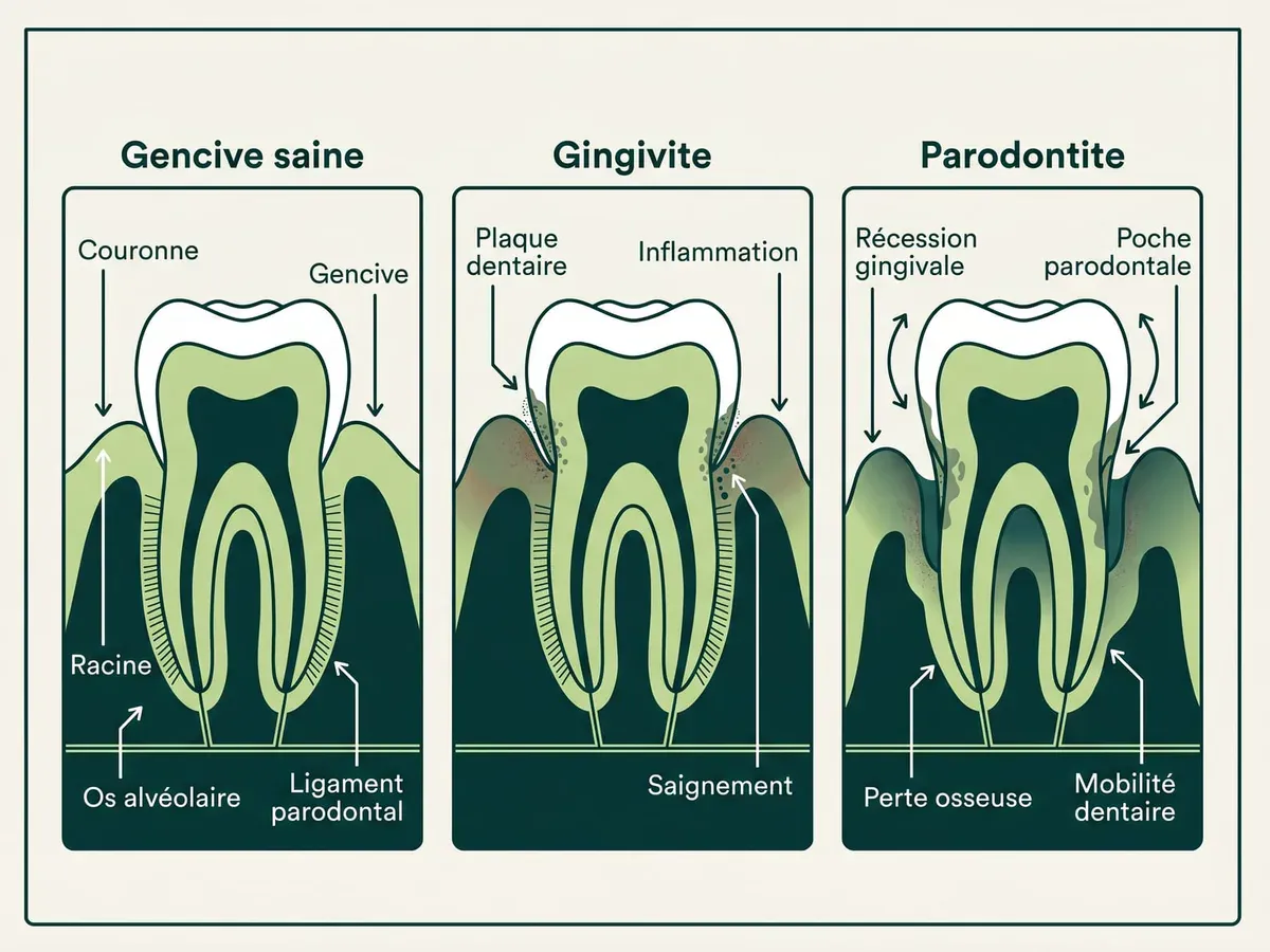 Parodontite ou gingivite : comprendre la différence