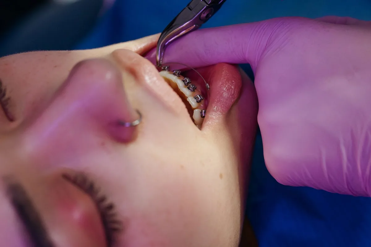 Ajustement de bagues orthodontiques sur les dents