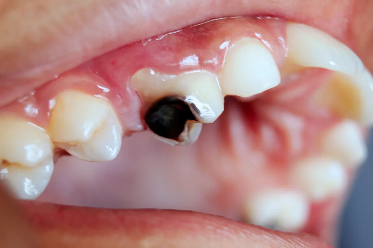 Photographie clinique d’une cavité carieuse sur une dent