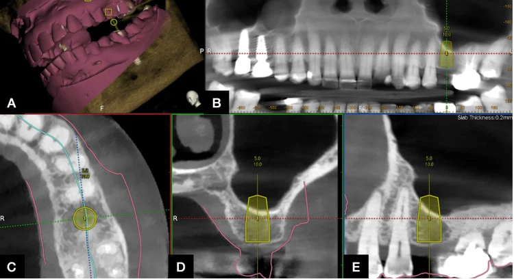Planification d’un implant dans le logiciel de navigation dynamique Navident