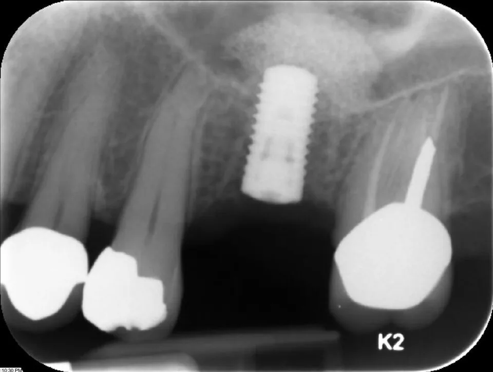 Radiographie d’un implant posé après élévation du plancher sinusien