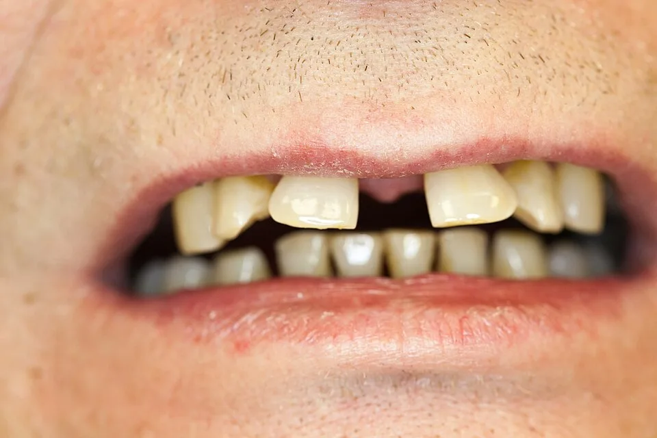 Déplacement dentaire dans un cas de maladie parodontale