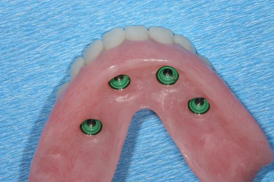 Face interne d’une prothèse amovible avec attaches implantaires