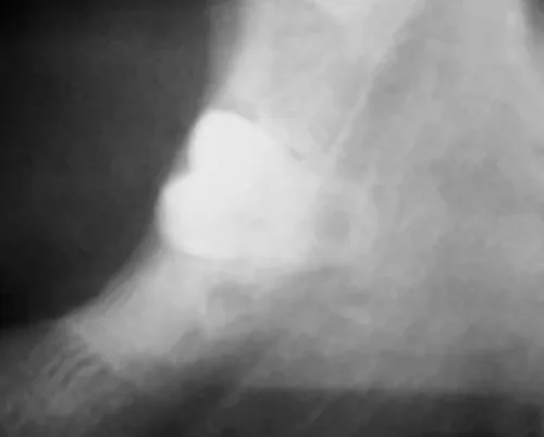 Radiographie d’une dent de sagesse incluse près du canal nerveux