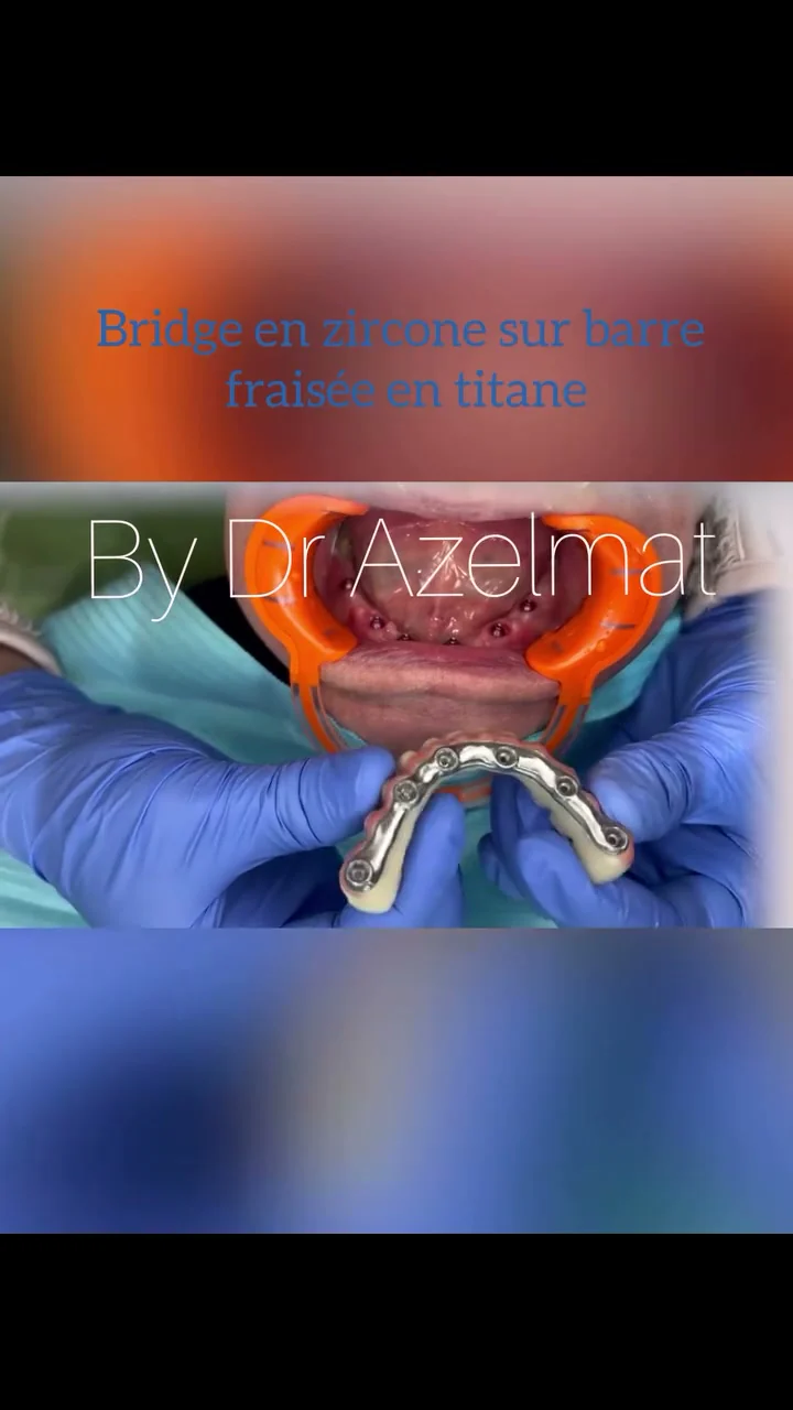 Barre en titane et bridge présentés pendant une séquence prothétique du cabinet
