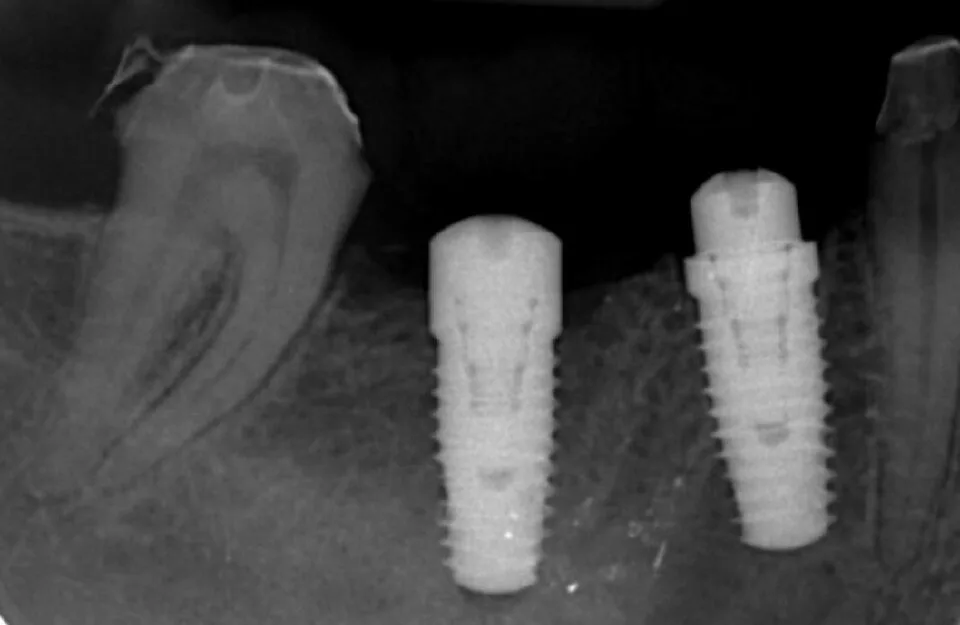 Radiographie de contrôle de deux implants et de l’os environnant