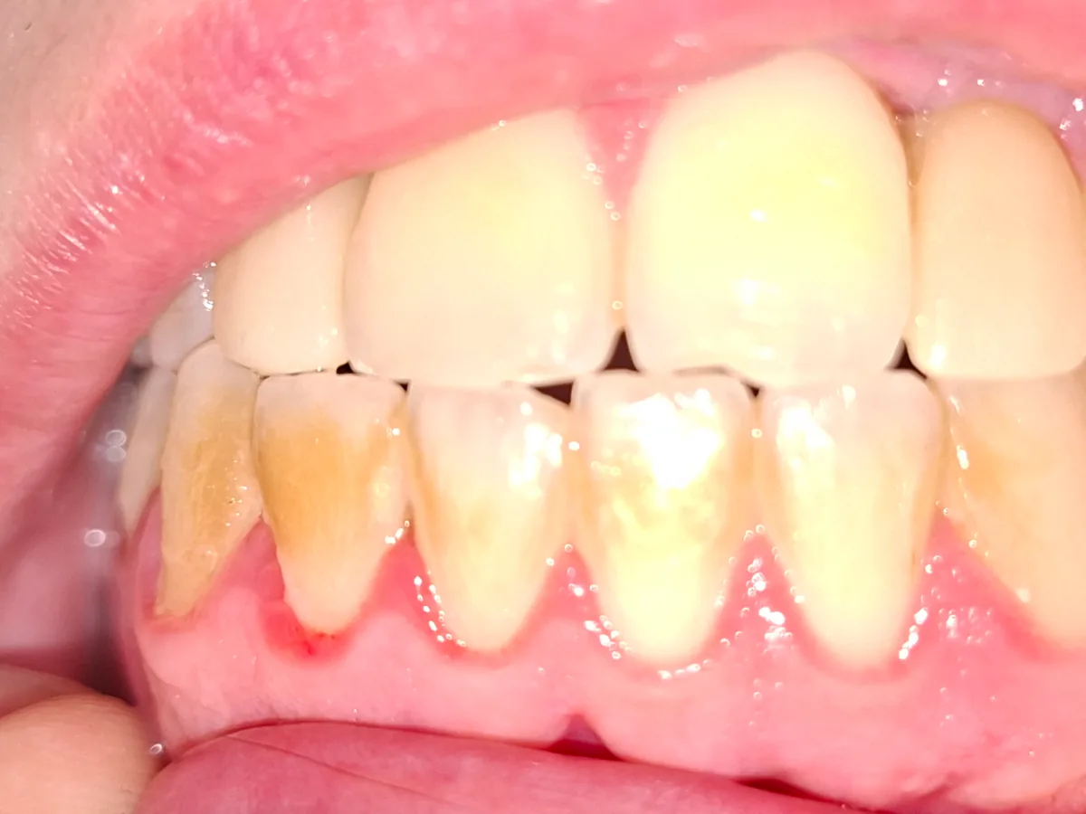 Photographie clinique des dents et du bord gingival