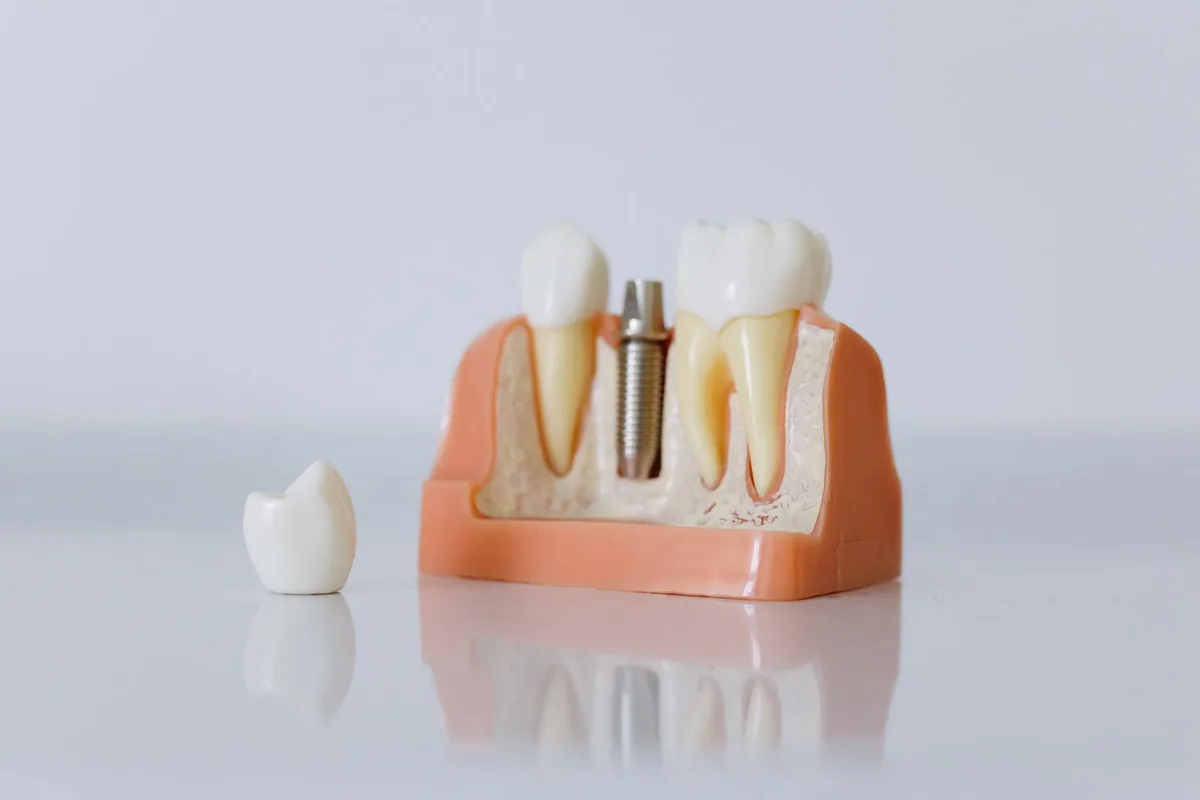Maquette anatomique avec implant métallique et couronne amovible