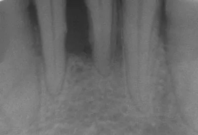 Radiographie montrant une perte osseuse autour des dents