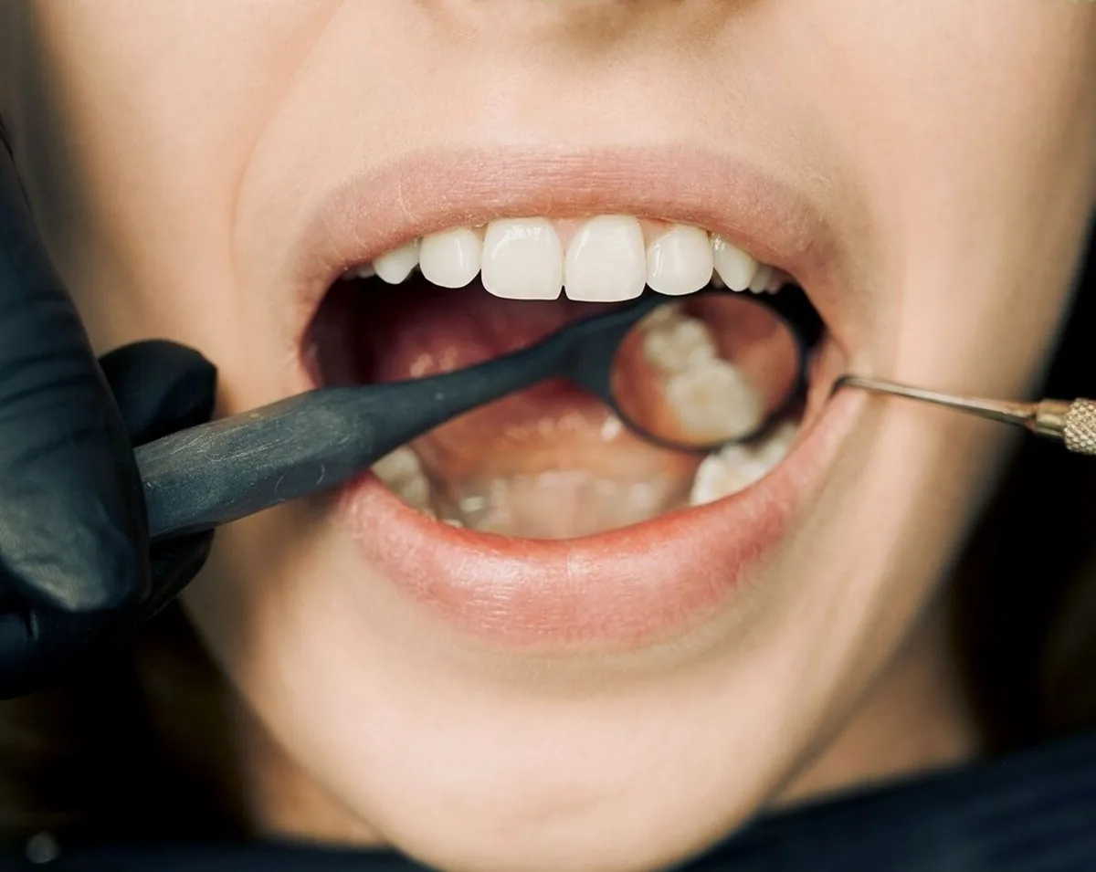 Examen des dents et du bord des gencives avec un miroir dentaire