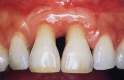 Récession gingivale avec racines dentaires exposées