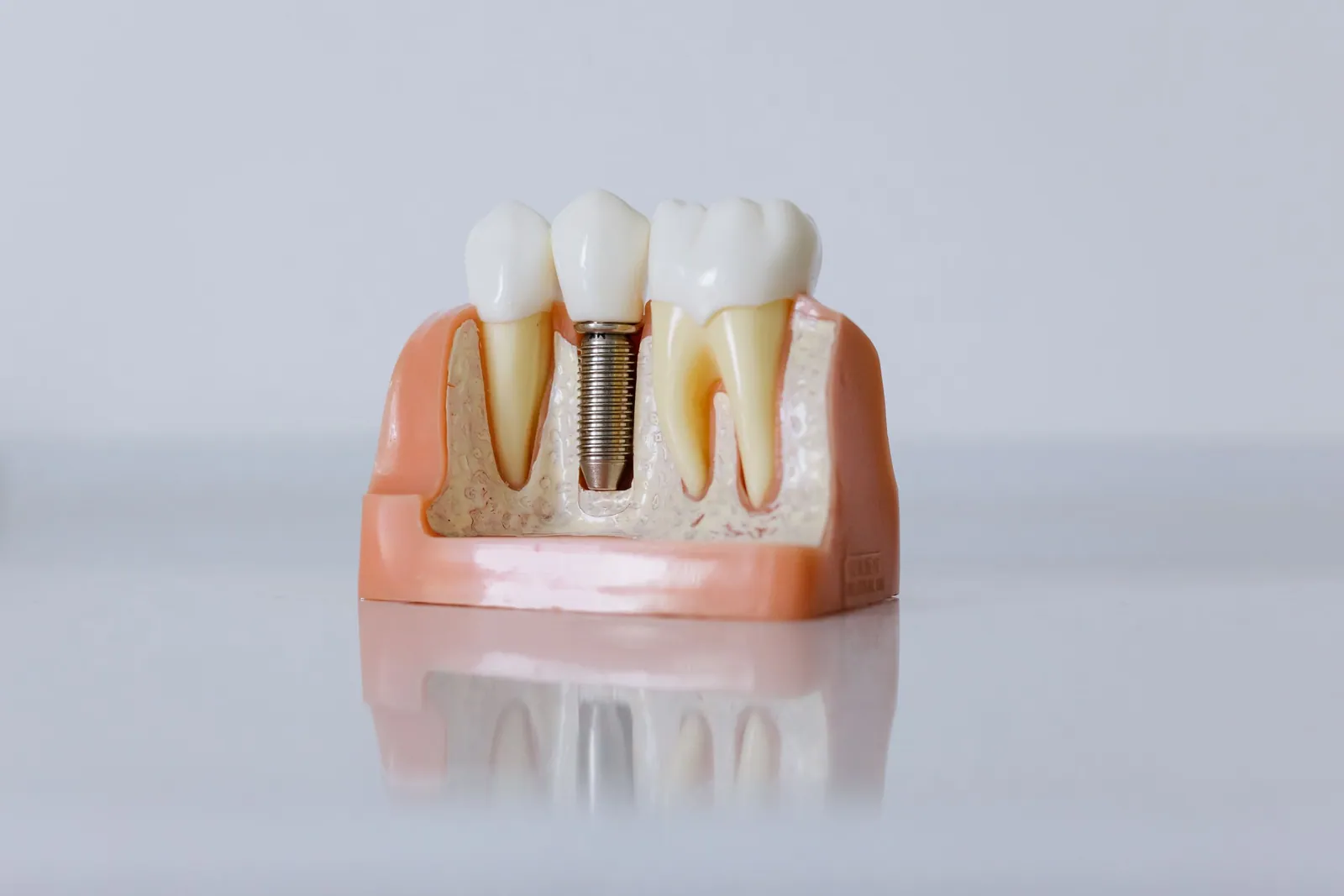 Modèle pédagogique d’un implant dentaire avec sa couronne, placé entre deux dents naturelles sur un fond blanc lumineux