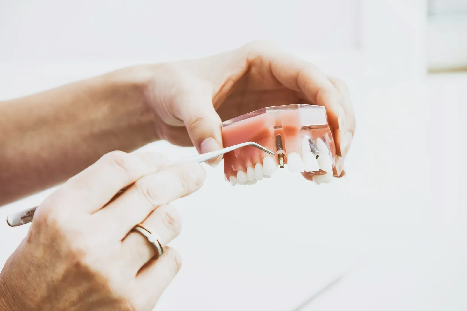 Mains tenant une maquette de mâchoire transparente avec deux implants, une sonde désignant l’un d’eux, sur fond blanc