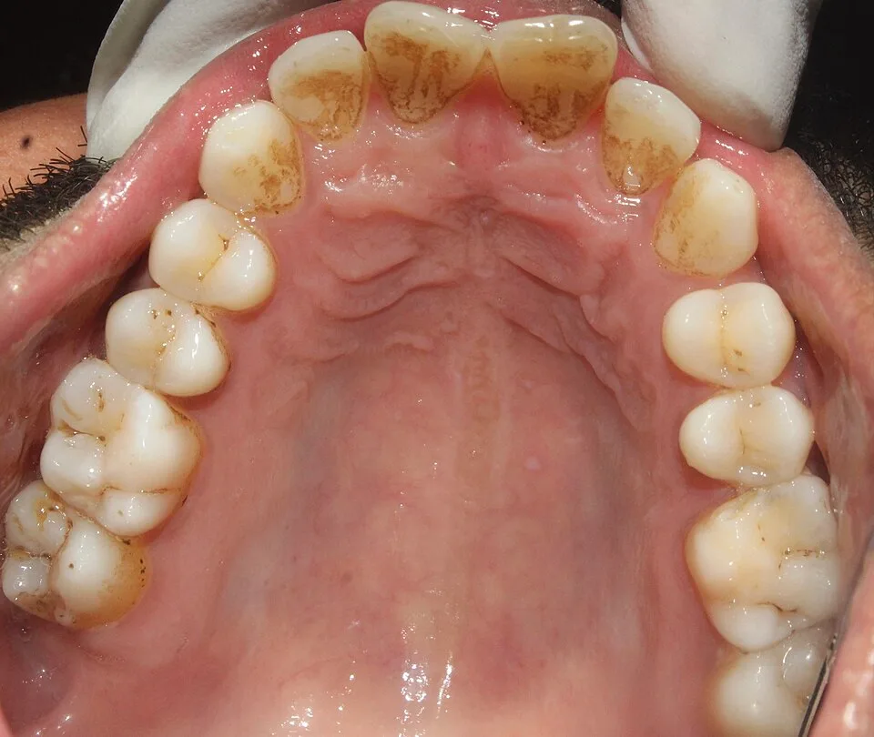 Dépôts de tartre visibles sur la face interne des dents
