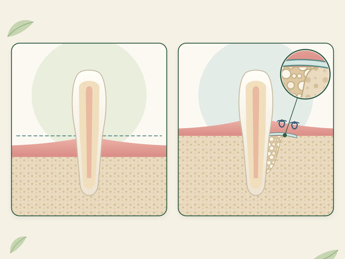 Deux dents en coupe : à gauche, l'os a baissé à plat sous un trait pointillé ; à droite, un creux étroit le long de la racine est comblé de grains sous une membrane.