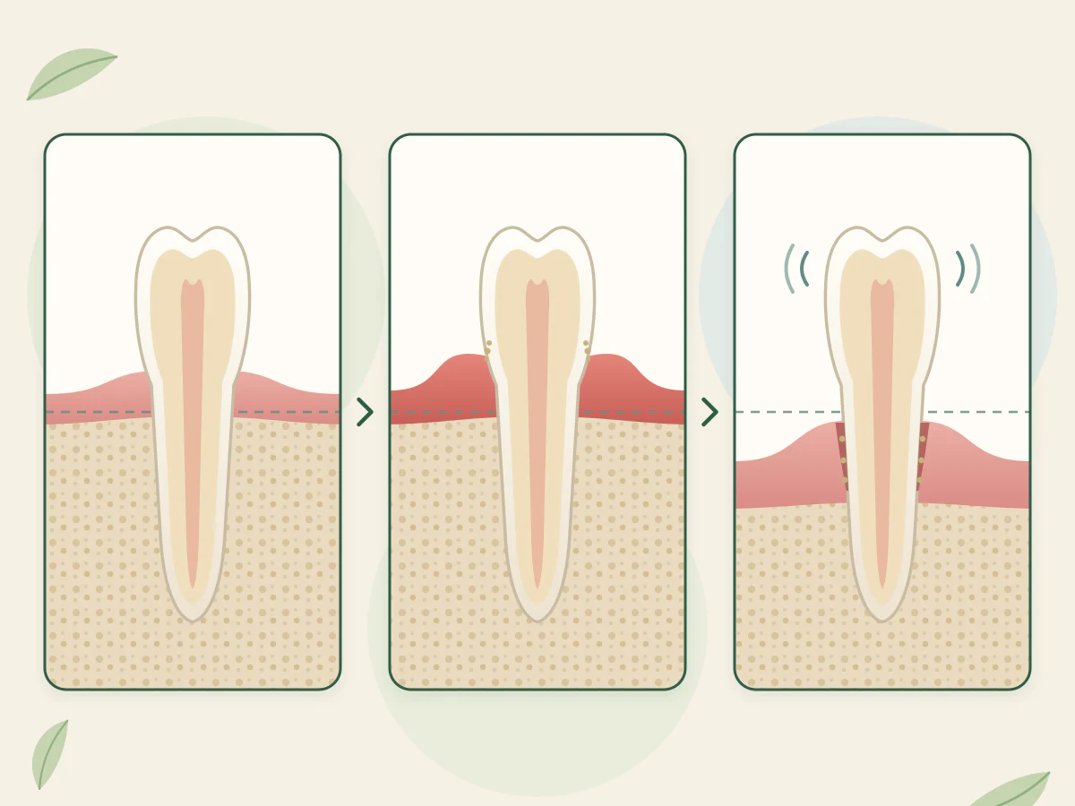 Trois coupes d'une même dent, de gauche à droite : gencive saine et os à sa place, gencive rouge et gonflée, puis gencive plus basse, poche le long de la racine et os descendu sous la ligne pointillée.