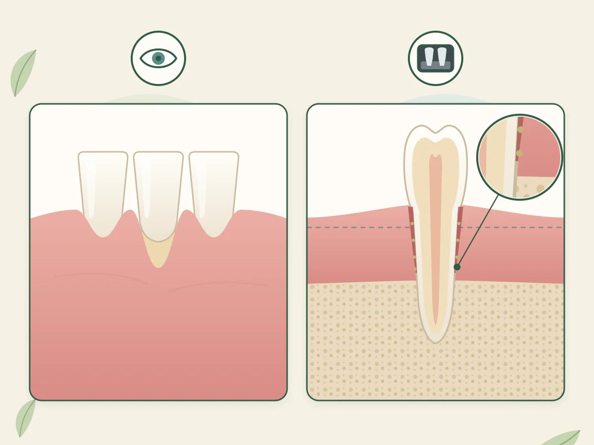 À gauche, sous un œil, trois dents vues de face dont celle du milieu paraît plus longue car sa gencive a reculé ; à droite, sous une radiographie, une coupe où la gencive semble normale mais où une poche descend jusqu'à un os plus bas.