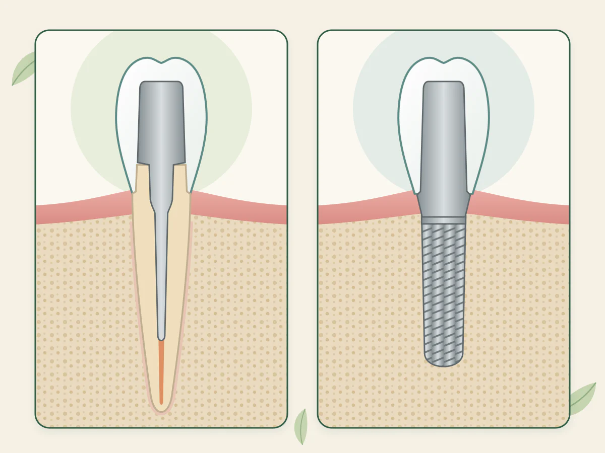 Deux coupes comparées : à gauche une racine dévitalisée porte un pivot et une couronne, à droite un implant en titane dans l’os porte un pilier et la même couronne.
