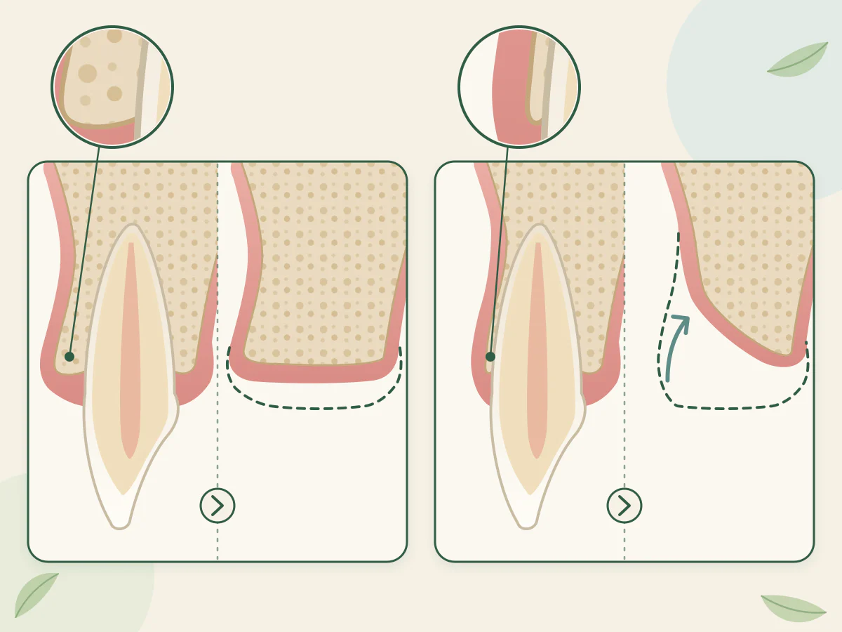 Dents de devant du haut vues de profil : paroi d'os épaisse côté lèvre, crête presque intacte après extraction ; paroi très fine, crête plus basse et plus étroite.