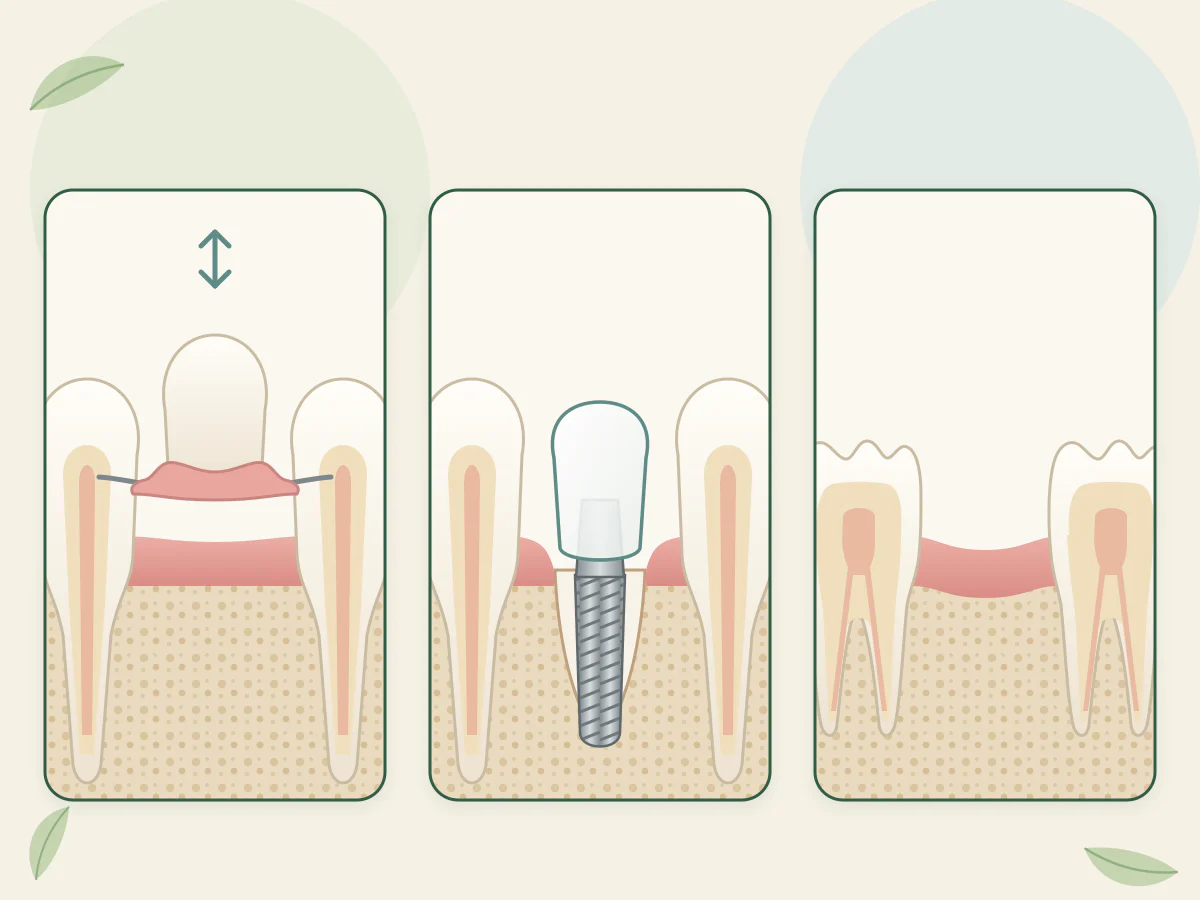 Trois options d'attente : dent amovible sur base rose avec crochets, soulevée pour montrer qu'elle se retire, implant avec dent provisoire, espace de molaire laissé vide.