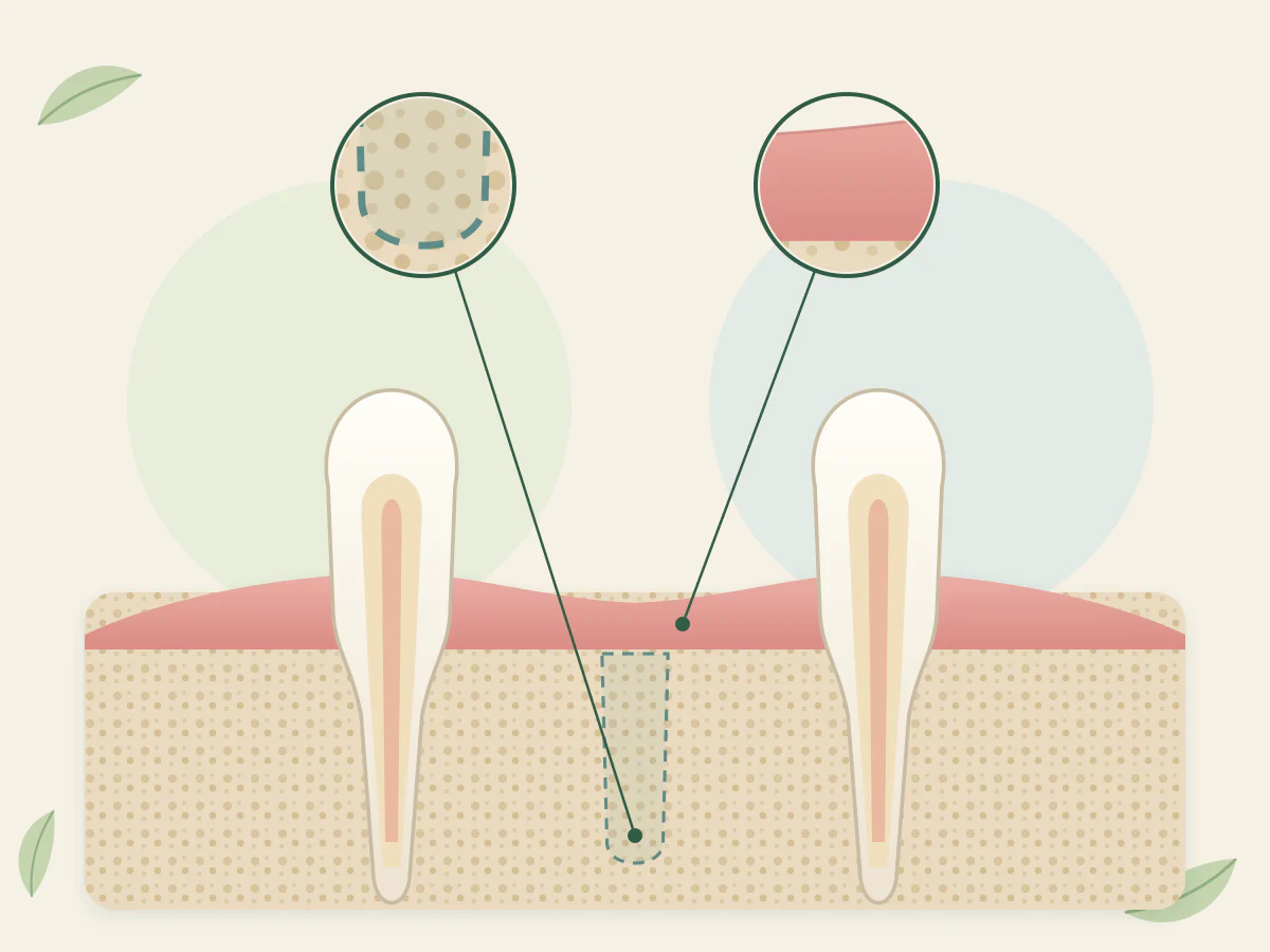 Coupe de mâchoire : entre deux dents, le contour en pointillés d'un implant prévu dans l'os, avec deux loupes, l'une sur l'os, l'autre sur la gencive.