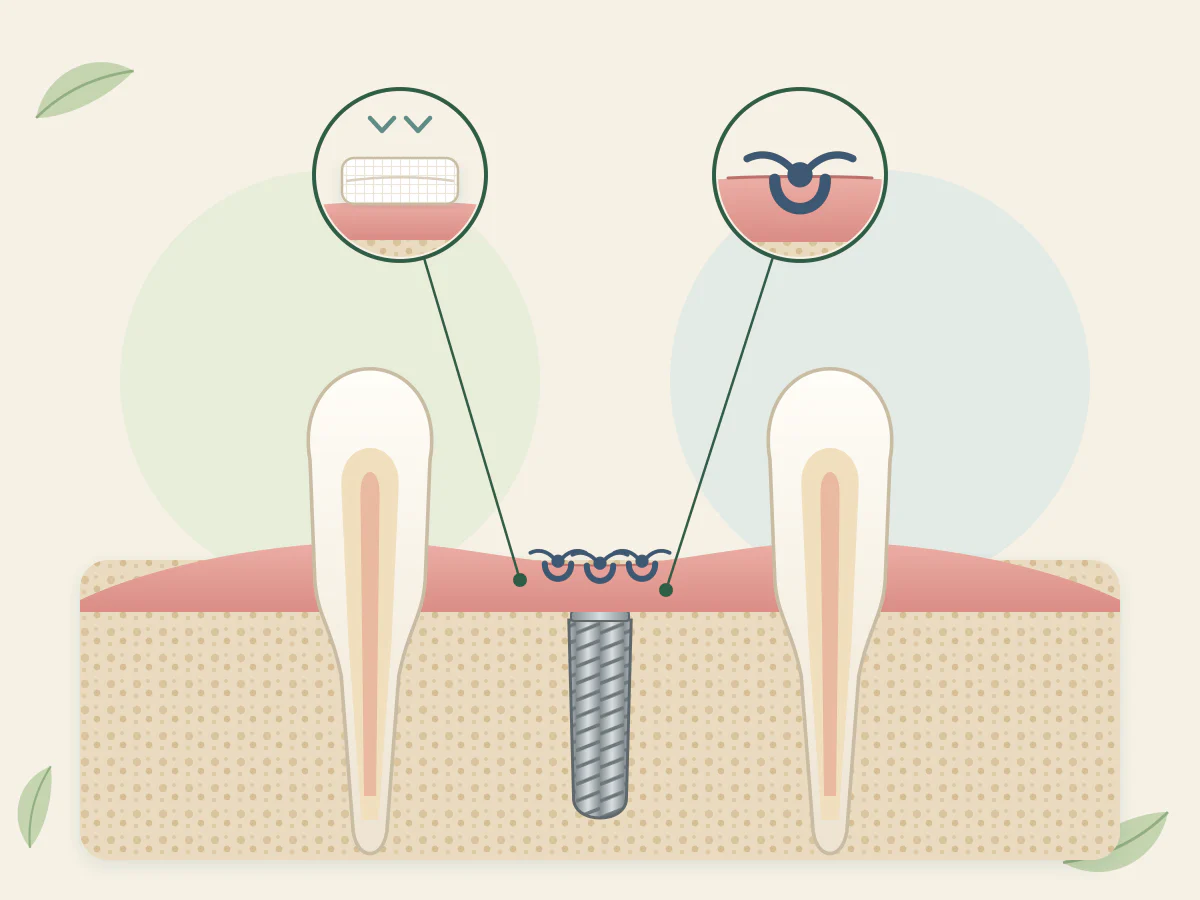 Implant posé dans l'os sous une gencive fermée par trois points, avec deux loupes : une compresse pliée appuyée sur la gencive et un point de suture.