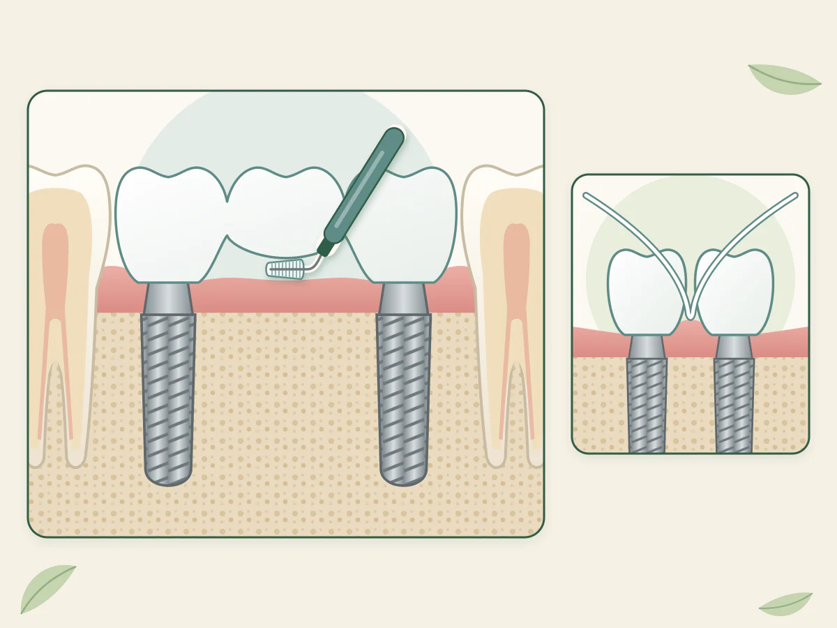 Brossette interdentaire passée sous la dent du milieu d'un bridge sur deux implants, et fil dentaire glissé entre deux couronnes sur implants séparées.