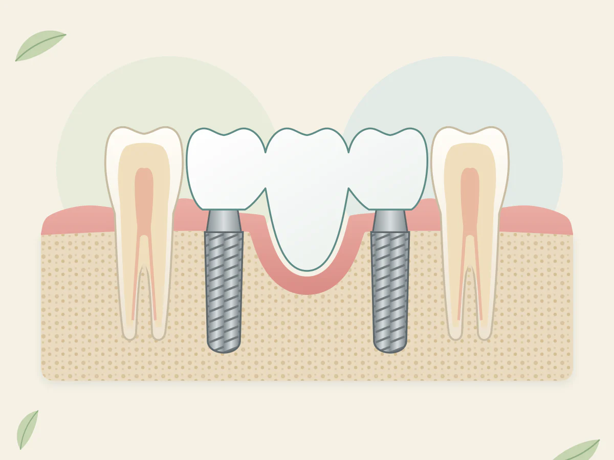Coupe de mâchoire où l'os se creuse au milieu d'un espace de trois dents : deux implants posés dans l'os plus épais des extrémités portent un bridge.