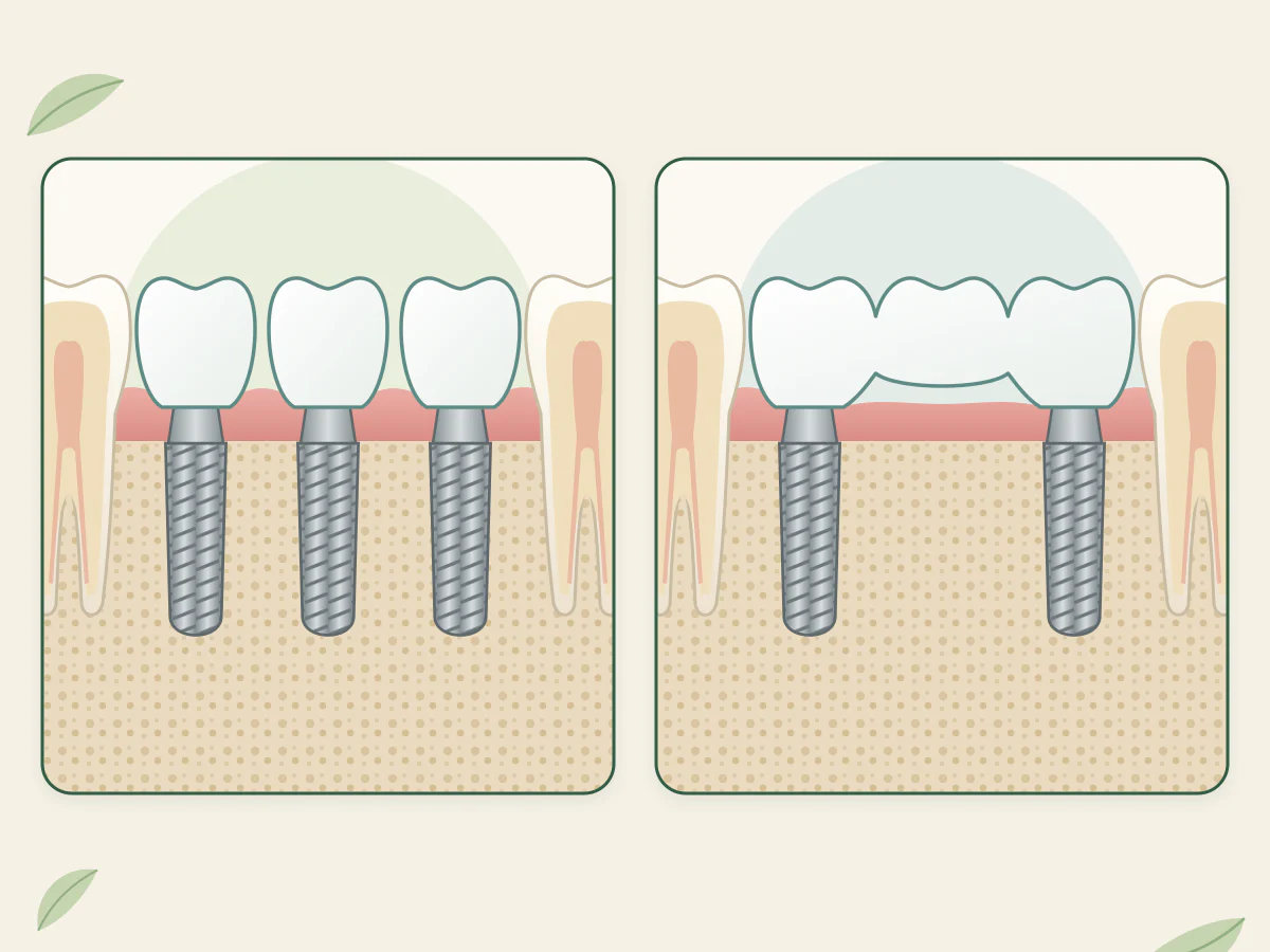 Deux coupes de mâchoire : trois implants portant chacun sa couronne, et deux implants aux extrémités portant un bridge de trois dents sans implant au milieu.