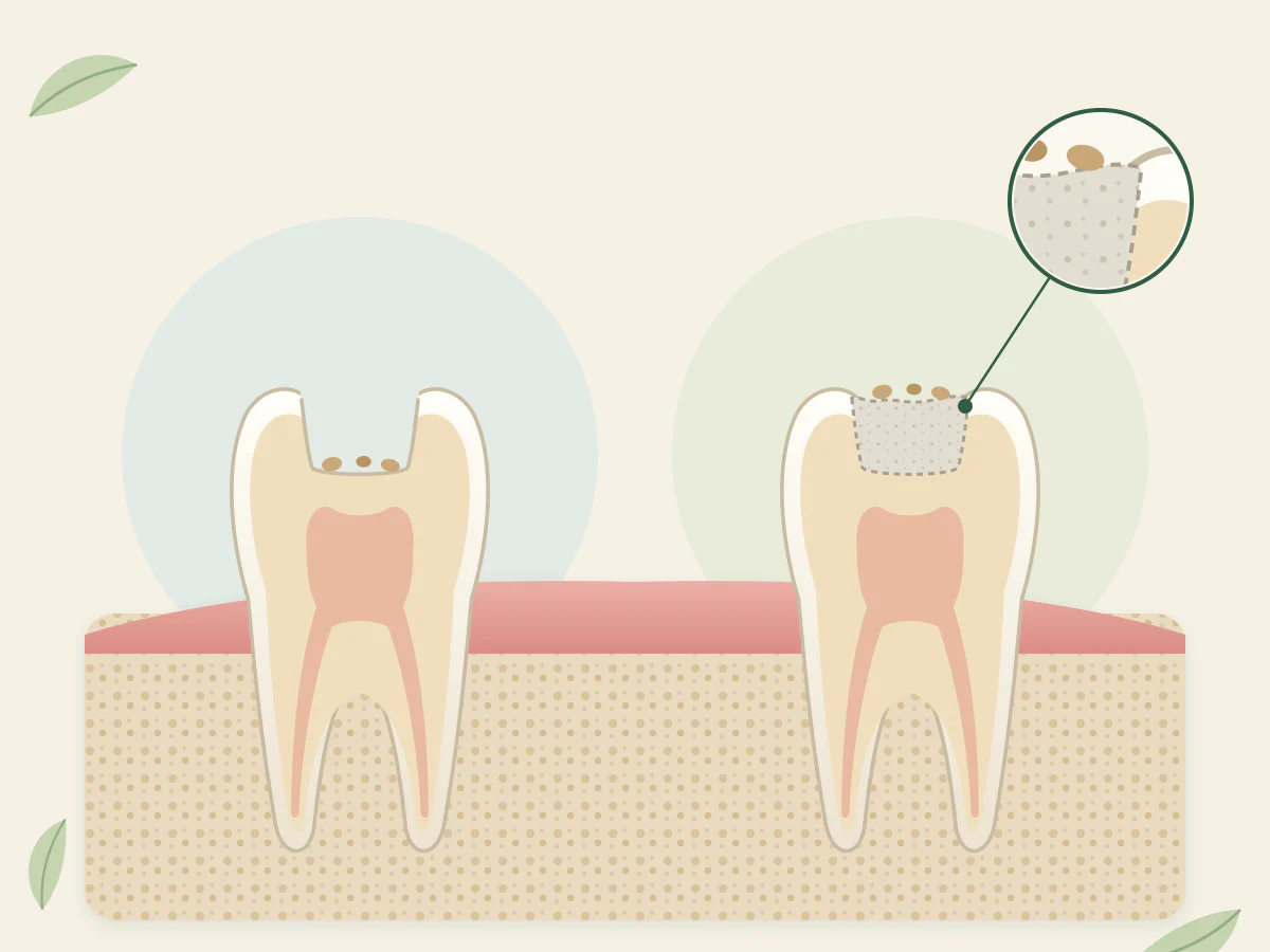Deux molaires en coupe : à gauche, des miettes sont tombées dans le trou d'un plombage perdu ; à droite, un pansement provisoire ferme le trou et les miettes restent dessus, un détail agrandi dans un cercle.